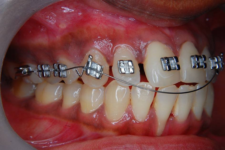 Orthodontic Treatment
