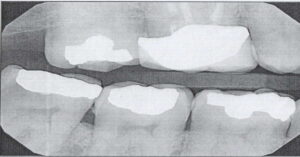 Broken or Chipped Tooth